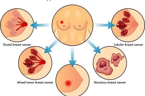 乳腺癌早期三处疼痛图,乳腺癌早期三处疼痛图详解与娱乐版实时数据解析,前沿解答解释定义_版荡85.98.68