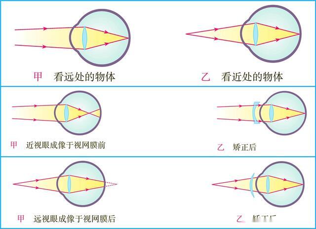 近视如何矫正视力baidu,近视如何矫正视力，Baidu知识与精细定义的探讨（版本 90.65.33）,实地验证执行数据_凸版44.81.31