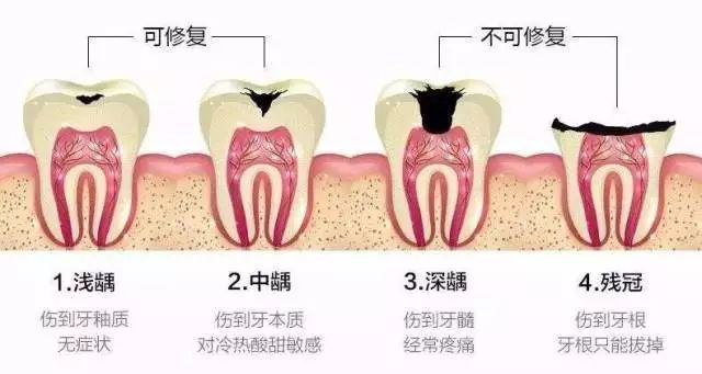 牙髓炎根管治疗需要多长时间,牙髓炎根管治疗全面设计执行方案及其所需时间,快捷方案问题解决_Gold55.42.39